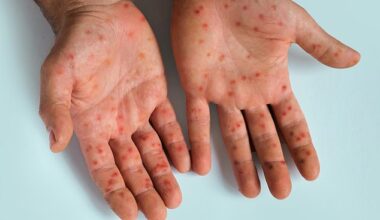 Travellers in Spain are being cautioned to 'take extra precaution' after a rise in cases of a more infectious mpox strain - characterised by fever and muscle aches and followed by a rash and painful sores (pictured)