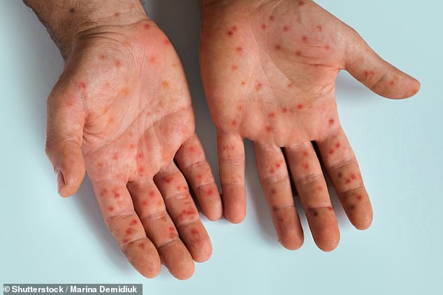 Travellers in Spain are being cautioned to 'take extra precaution' after a rise in cases of a more infectious mpox strain - characterised by fever and muscle aches and followed by a rash and painful sores (pictured)