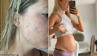 I struggled with stubborn acne that wouldn’t budge and bloating