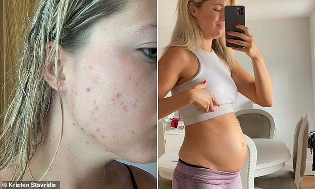 I struggled with stubborn acne that wouldn’t budge and bloating