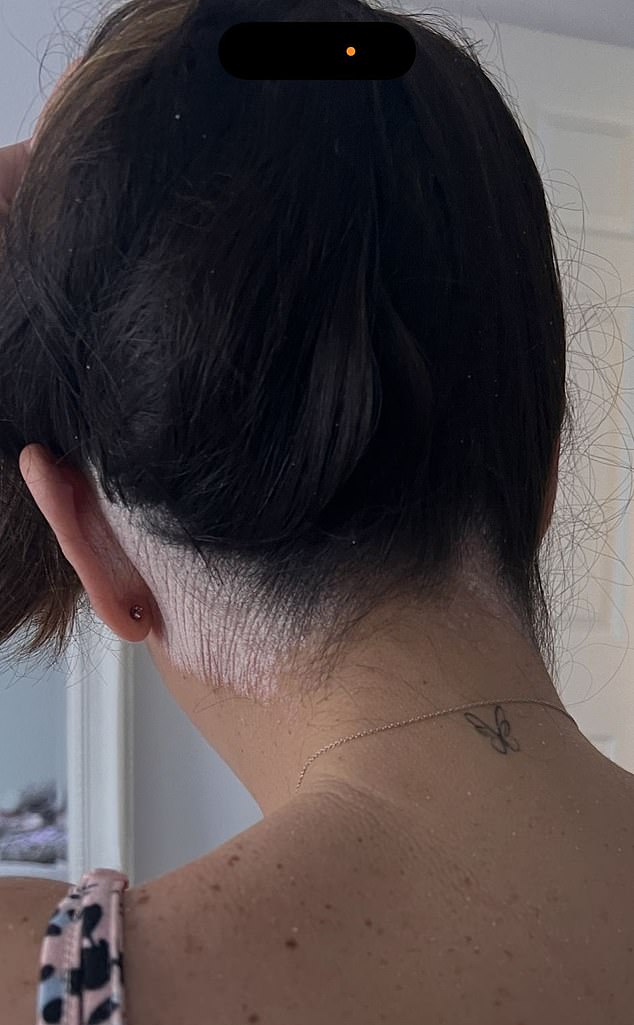 Ellena's psoriasis also results in flaking skin from her scalp, meaning she avoids wearing black