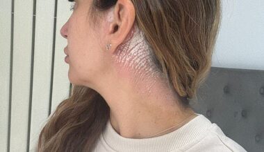 Ellena George has suffered from painful scalp psoriasis from the age of 11