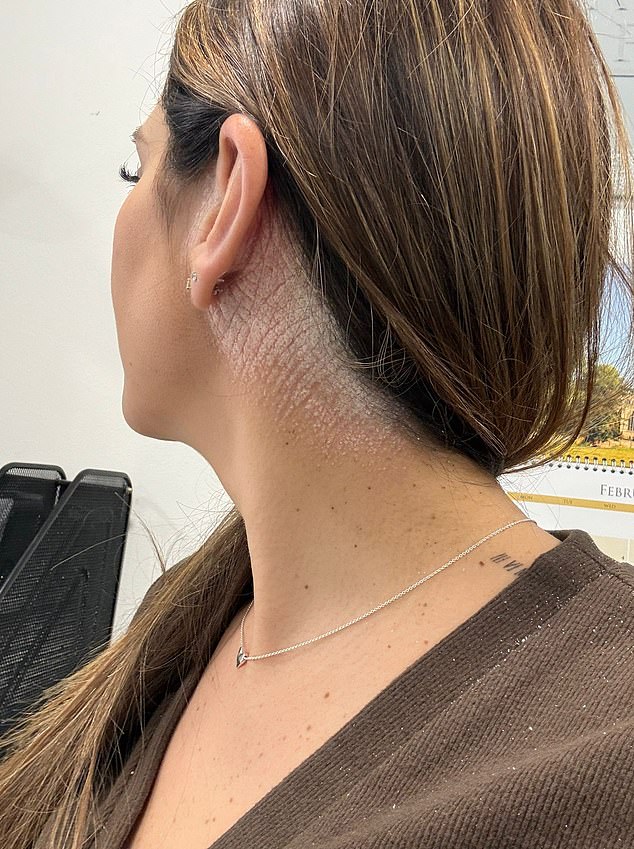 The condition causes painfully itchy, dry and red skin, as well as self-consciousness