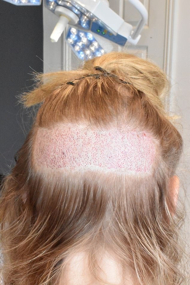 After scrutinising my scalp, Dr Gho said he could help. When we were finally finished, I looked like Frankenstein’s bride with a speckled purple hairline