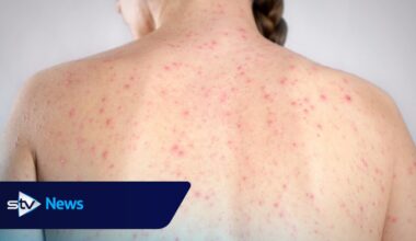 Second case of measles confirmed in NHS Grampian