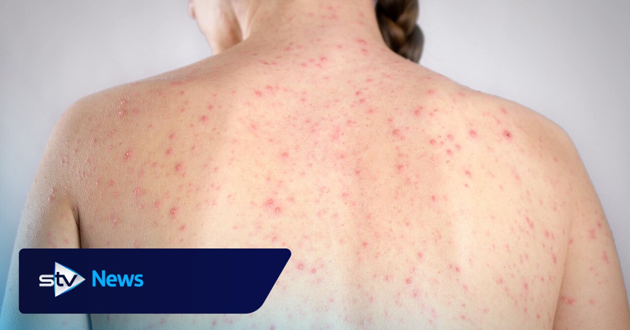 Second case of measles confirmed in NHS Grampian