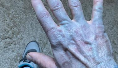 I woke up blue and rushed to hospital, then the doctors started laughing