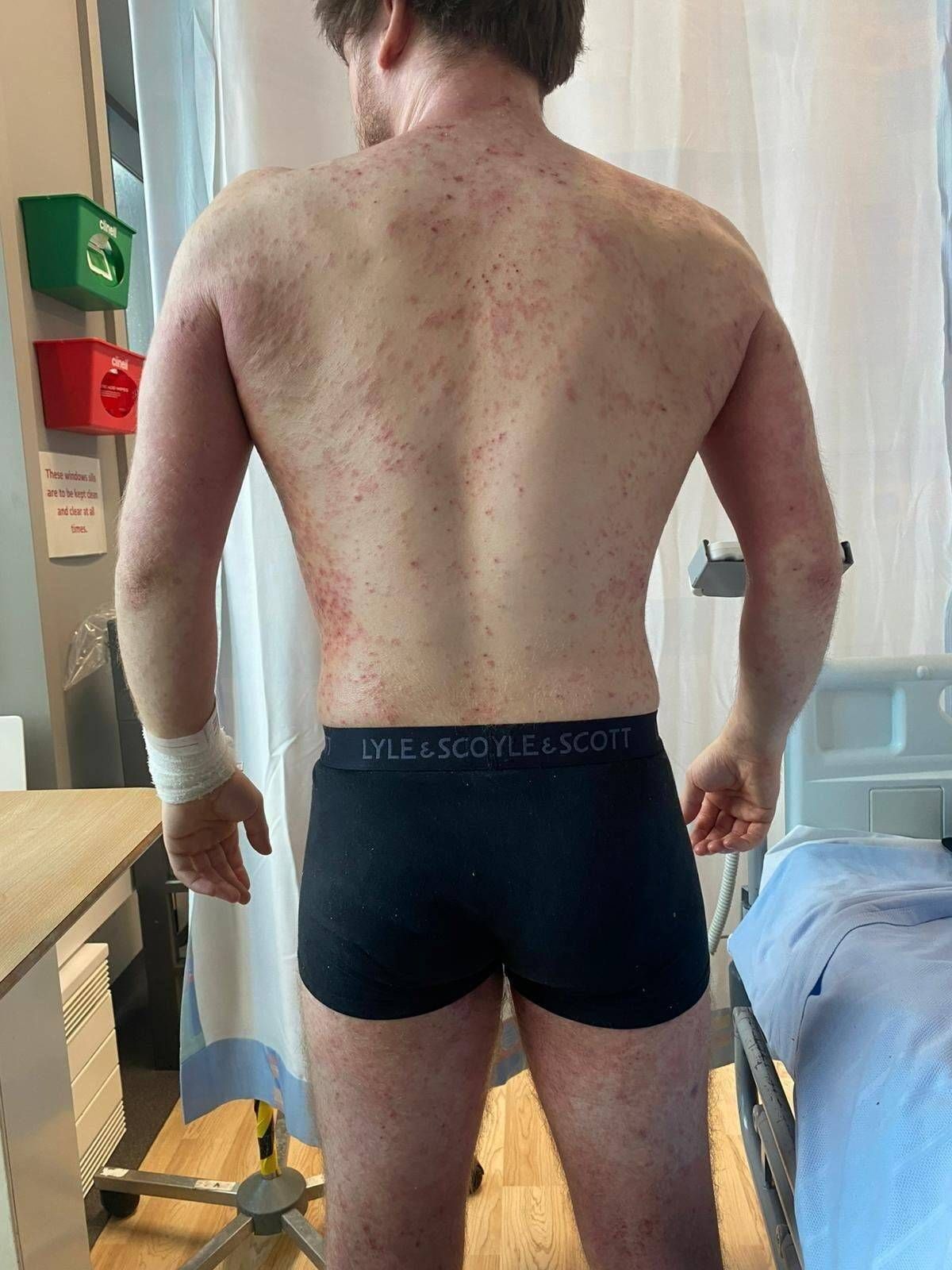 A rear view of a Callum standing in a clinical setting, wearing dark-colored shorts, next to a hospital bed