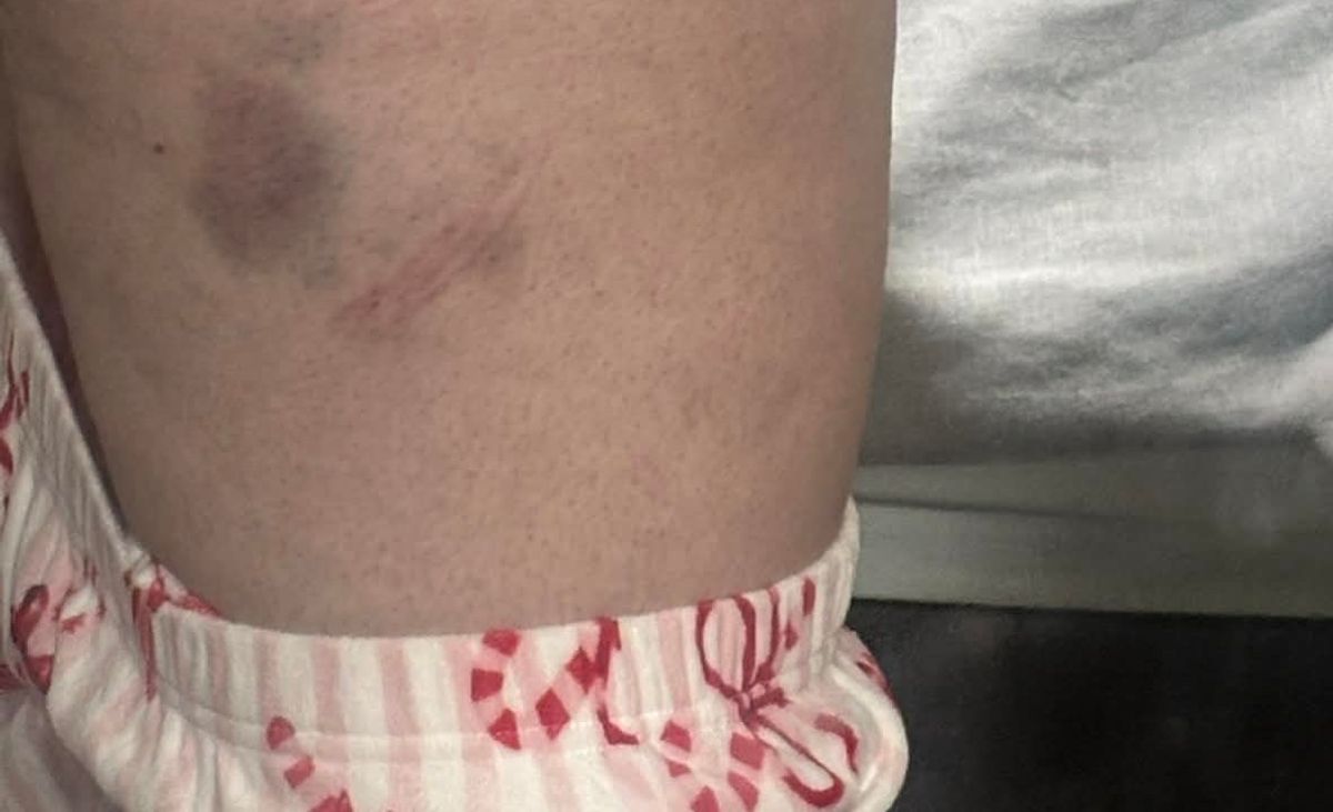 Bruising on Torileigh New's body