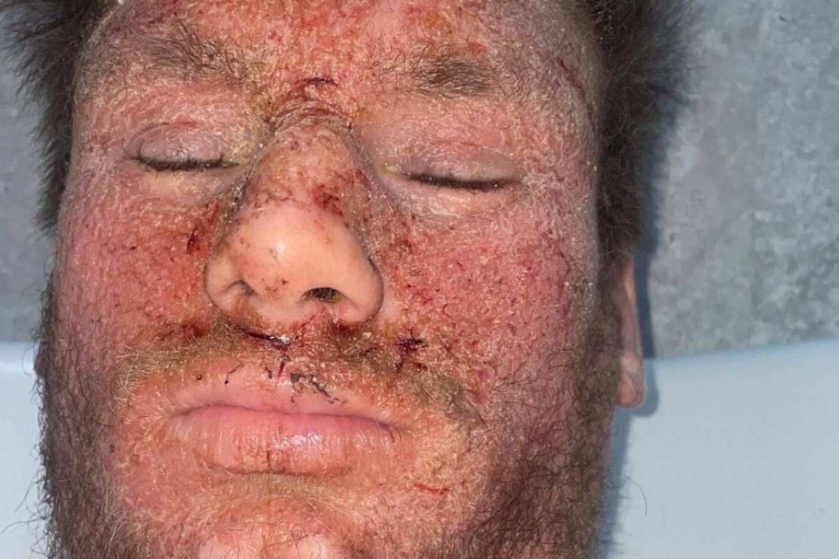 Callum seen with his eyes closed and the skin on his face and upper body flaking