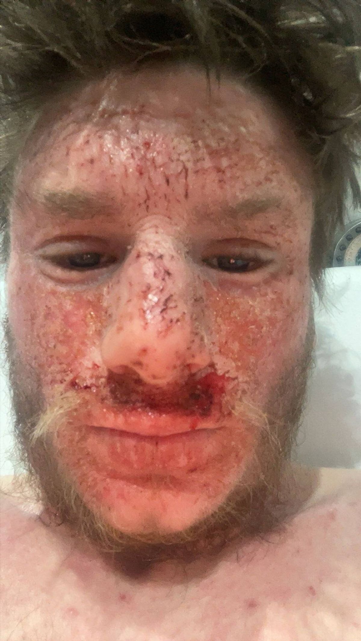 Callum's face shows burns and abrasions as he lies on a hospital bed, displaying visible signs o