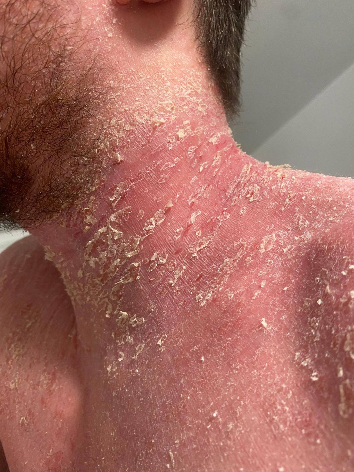 Close-up view of a skin condition characterized by a widespread rash and white powdery substance covering the neck and shoulder