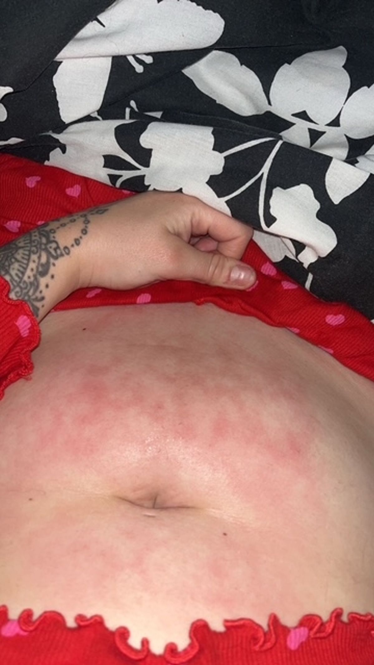 'Toasted skin syndrome' caused by years of using heat to combat pain