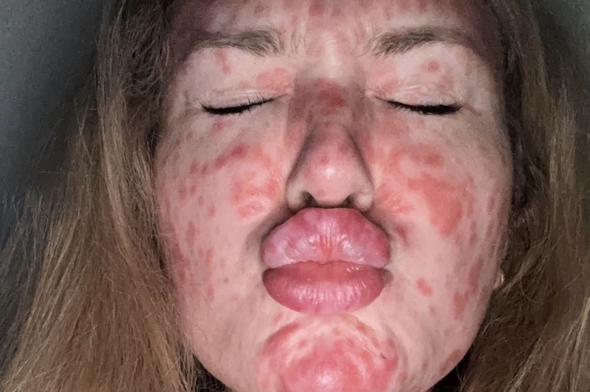 Jayne had to go to hospital her rash was so severe