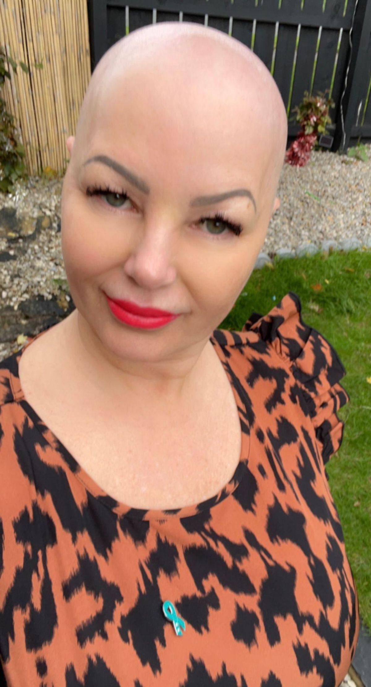 Emma Durkin lost her hair while going through chemotherapy 