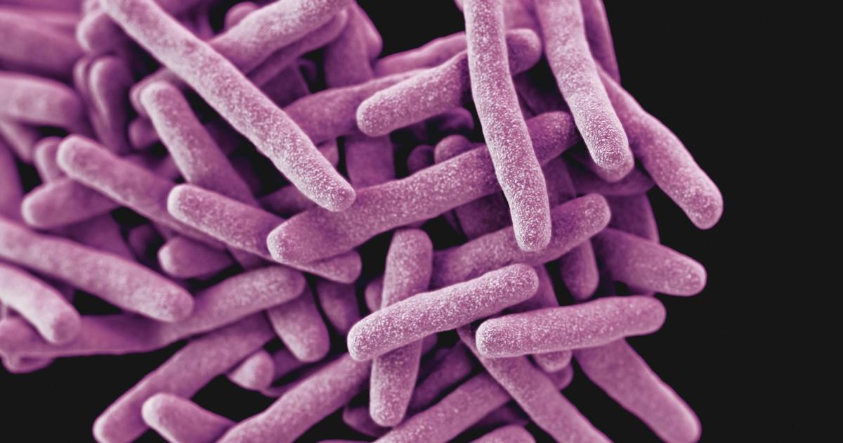 Case of Tuberculosis confirmed at New College Swindon