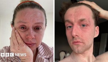 Three photos of Bethany. In the first pic she is holding her phone to take a selfie. She looks healthy and her skin is clear. In the top right pic she has shaved her hair off, in the bottom right pic her cheek skin is bright red and peeling