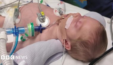 Carson in hospital in Winchester. He is 10 weeks old and lying in a hospital bed with various tubes coming out of his body and sensors on his skin. There is a white blanket rolled under his neck and he has a head of short blonde hair.