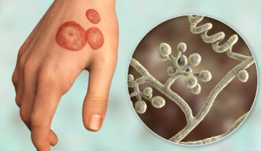 Ringworm is rife in UK gyms and barbershops — but many don't spot it