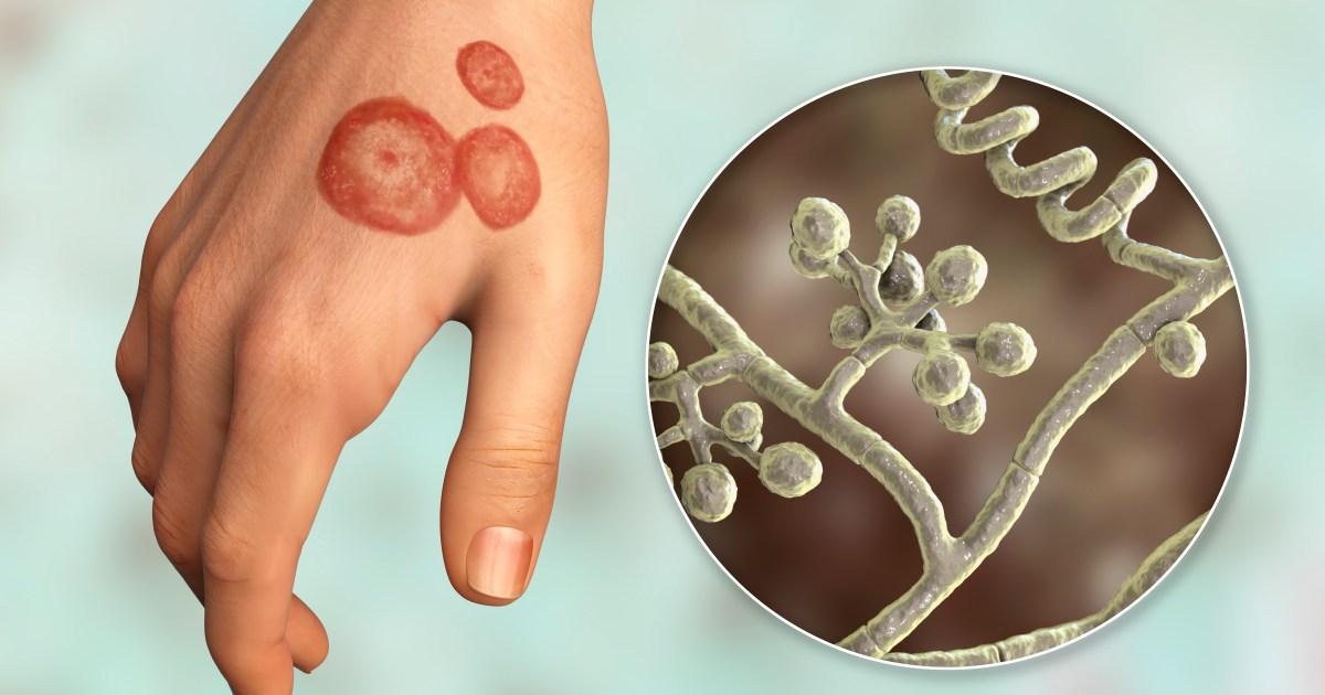 Ringworm is rife in UK gyms and barbershops — but many don't spot it