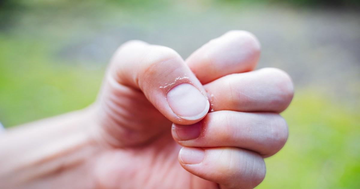 What changes to your fingernails can reveal about your health