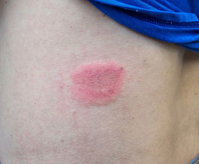 ringworm infection of the Body skin. Closeup view