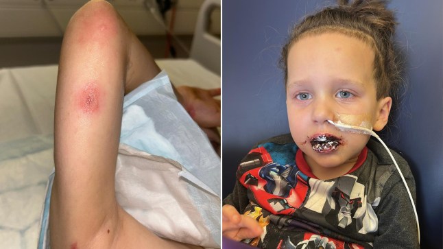 Left: Mylo's arm with a large blister on it. Right: Mylo with severe blisters on his mouth and a tube going into his nose