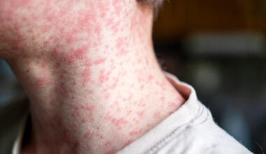 At least 80 children have been infected with measles in just one London borough | News UK