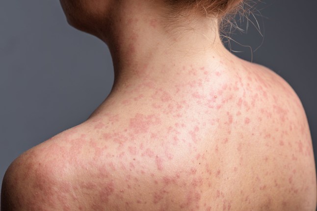 A woman with a red, spotty rash on her upper back and shoulders caused by measles.