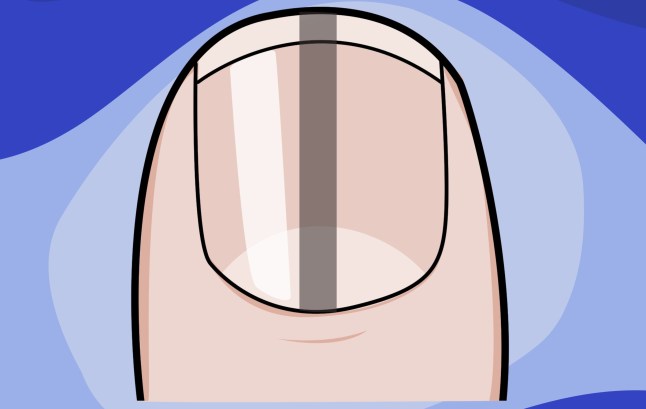 What your fingernails can tell you about your health example: black line Picture: Myles Goode