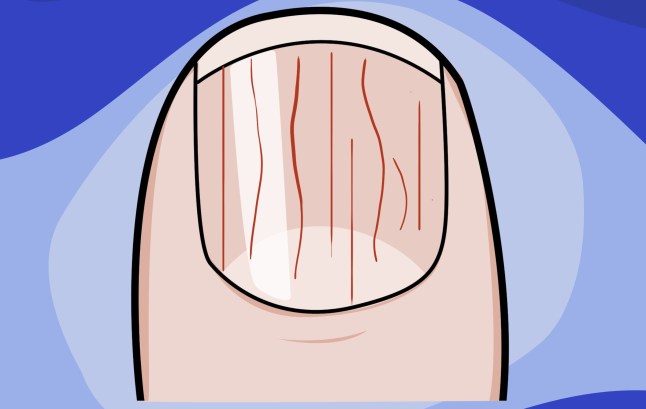 What your fingernails can tell you about your health example: upright ridges Picture: Myles Goode