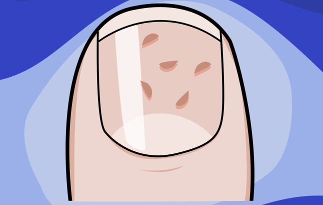 What your fingernails can tell you about your health example: pitting Picture: Myles Goode