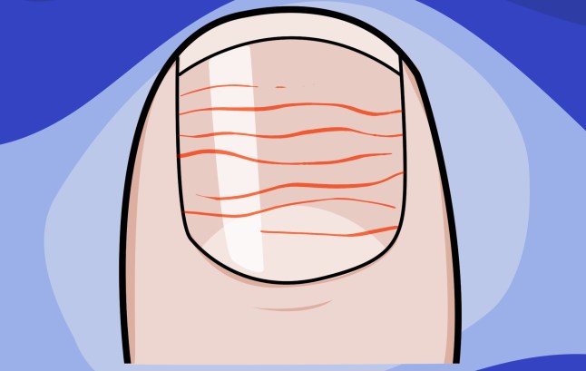 What your fingernails can tell you about your health example: horizontal ridges Picture: Myles Goode