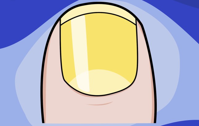 What your fingernails can tell you about your health example: yellow Picture: Myles Goode