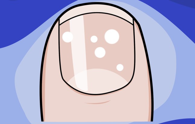 What your fingernails can tell you about your health example: white spots Picture: Myles Goode