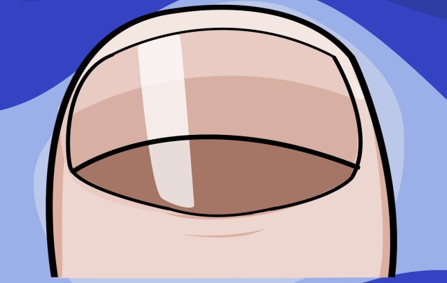 What your fingernails can tell you about your health example: clubbed nails Picture: Myles Goode