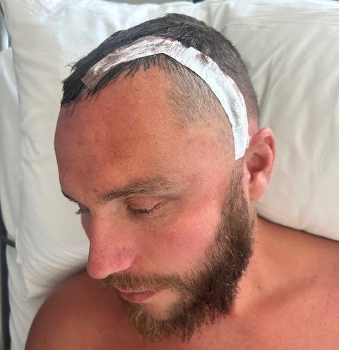 Story from Jam Press (Brain Tumour Diagnosis) Pictured: Lewis post-surgery. ?Test for stomach ache found tumour growing in my BRAIN ? I had surgery while AWAKE to remove it? A man has shared how a simple test for stomach pain resulted in a life-changing diagnosis. Lewis Goodfield had been struggling with abdominal issues for ?several years? ? so much so that the pain had become ?relentless?. When he couldn?t take any more, the services engineer was admitted to hospital with abdominal pains ? but news of a brain tumour was the last thing he was expecting. ?I collapsed in pain while in hospital and nurses assumed I?d had a seizure,? the 37-year-old, from Beddau, Wales, told creatorzine.com. ?Then a CT scan showed a mass on my brain. ?It was a huge shock ? not just for me but for friends and family, too. ?It hit me hard.? Lewis had been focused on getting answers to his stomach issues and never expected to be told something so life changing. The father-of-two had already been admitted to hospital twice for the mystery pain before he visited in March 2025, when he collapsed in agony. Concerned he?d had a seizure, staff performed a CT scan, which revealed the mass. The following month, Lewis was told by doctors he had a grade two glioma, a form of brain tumour that often progresses to a higher grade through time. The stomach pain is believed to be unrelated, meaning the tumour was found by chance. Recalling the moment he was told about the mass, Lewis said: ?It was a massive shock. ?It was slow growing, not aggressive. ?Recovery has been tough but it's going well. ?I'm just trying to remain as strong as I can.? Lewis was given with two options: to monitor the mass, or surgery to remove it. He opted for surgery ? a craniotomy procedure where a section of the skull is temporarily removed to access the brain, which he remained awake for ? in July last year. Lewis added: ?I could hear all the drilling and conversations. ?It was really strange and just a lot to take in. ?My neurosurgeon showed me the tumour in the palm of her hand. ?I was a bit shocked to see it. ?It was about the size of an egg. ?It's a lot to deal with.? Lewis? operation was a success and the brain tumour was not cancerous, so doctors believed it was found early enough. He praised his family, particularly wife Keeley, for their help with his recovery. He added: ?Keeley has borne the most of this. ?She's had support from family and friends but she's largely dealt with it all on her own. ?I would never?had?been able to remain positive or stick with my daily tasks if it?wasn?t?for Keeley. ?She has been incredible, especially with me not being able to drive. ?The pair of us have really fought and recently the realisation of what we've been through has kicked in. ?We've been reflecting on that?and?it's?really hit home.? Since the surgery, he has been unable to drive or work, and his mysterious stomach issues have continued ? leaving him returning to hospital frequently, including in March for the fifth time this year. He said: ?I can't live my life like this. ?I've tried different diets and gave up spicy foods, then I gave up alcohol for a couple of months ? all sorts. ?It doesn't help. ?I think I've now had 10 CT scans, various MRI scans and x-rays, a colonoscopy and two endoscopies and I've got another one scheduled for this week. ?Then I need a capsule test, where you swallow a capsule and they track it through your digestive system.? So far, Lewis? doctors have been unable to diagnose his stomach problems. He added: ?My consultants are confused about what this might be. ?It's a bit of a mystery. ?One of them said, ?You might have to live with this?. ?I said, ?I'm sorry, I can't, there's got to be an answer?.? Meanwhile, the brain surgery has had a strong impact on his life, too. Since having the mass removed from his brain, Lewis now struggles with busy environments, while noise and bright lights bother him more than before. He?s also had to build up his memory function, which he says is improving week by week with the help of family and friends. Lewis has even been raising money for The Brain Tumour Charity and has raised more than ?3,600 despite having to postpone The Twilight Walk due to his stomach issues. He said that while his two children, Jake and Ralph, were ?fairly unaware? of his full diagnosis for a while, he?d shared the importance of the charity with them when arranging his fundraising efforts. He added: ?I need to be fit enough to do [the walk] but talking about this has been fantastic. ?I've had so many messages of support and people joining the walk - some I only know through a friend of a friend. ?Some have been affected by similar issues. ?It's so good for us to talk things through. ?I thought there would be 10-15 people on the walk but now there are 60 plus - I've created an event in my small village. ?I went to a meeting last November and was asked to speak, and from that point onwards I've had this positive mentality about staying committed.? ENDS