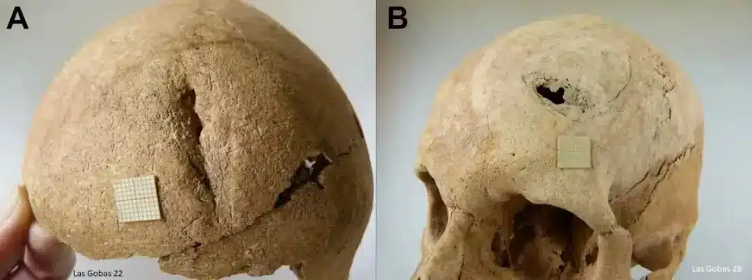 The Image Shows Two Skulls From The Las Gobas Site, Revealing Signs Of Violent Trauma.