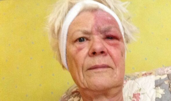 Jan with shingles Jan with shingles