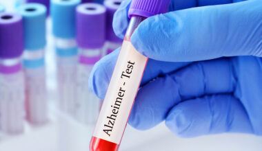 Blood test predicts dementia 25 years before symptoms appear