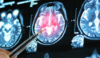 Experimental drug restores memory loss caused by Alzheimer's