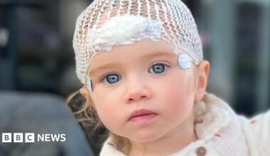 Tilly looks into camera with hospital dressings on her head at Sheffield Children's Hospital.