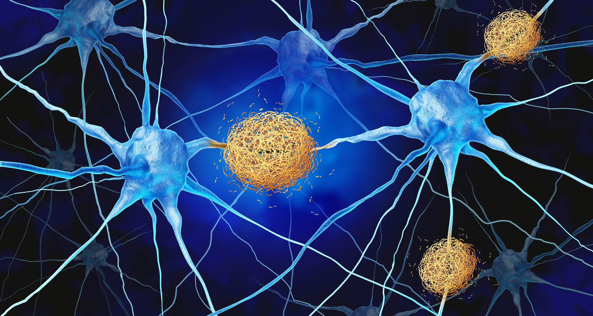 Normal brain immune cells may actually be causing Alzheimer's