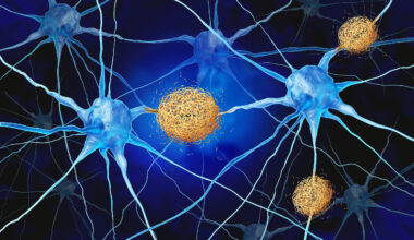 Normal brain immune cells may actually be causing Alzheimer's