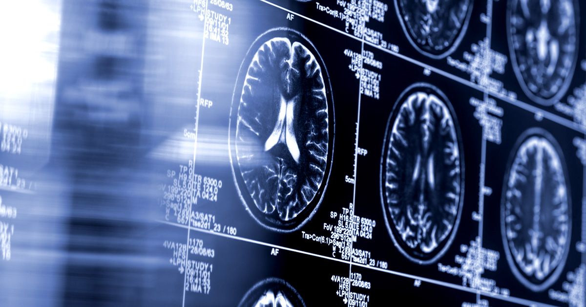 AI-driven stroke tool shows improved outcomes in major clinical trial