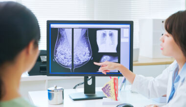 AI Integration in Breast Cancer Screening Increases Detection Rate, Reduces Work Burden