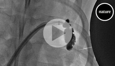 Magnetic gel injected into the heart could stop strokes