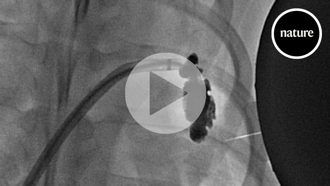 Magnetic gel injected into the heart could stop strokes