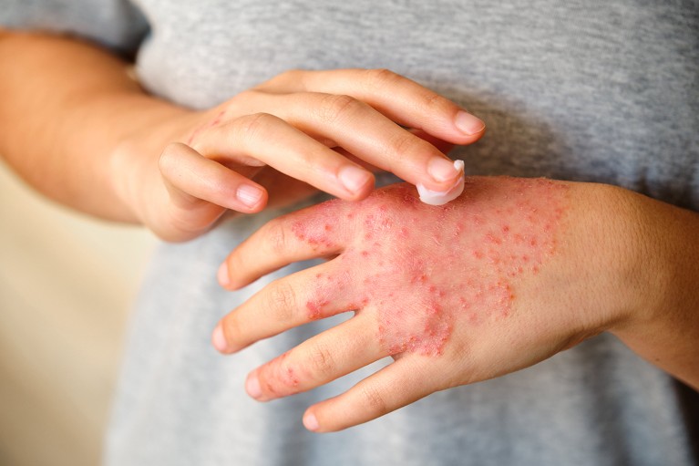 Close up view of a woman's hands as they applies a moisturizing cream to the eczema affecting the back of her left hand.