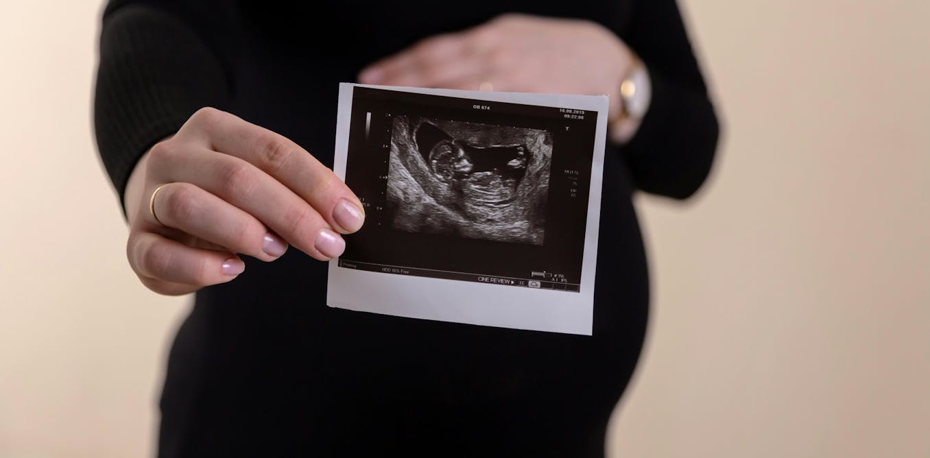 Can the placenta predict schizophrenia risk? Lessons from prenatal cannabis exposure